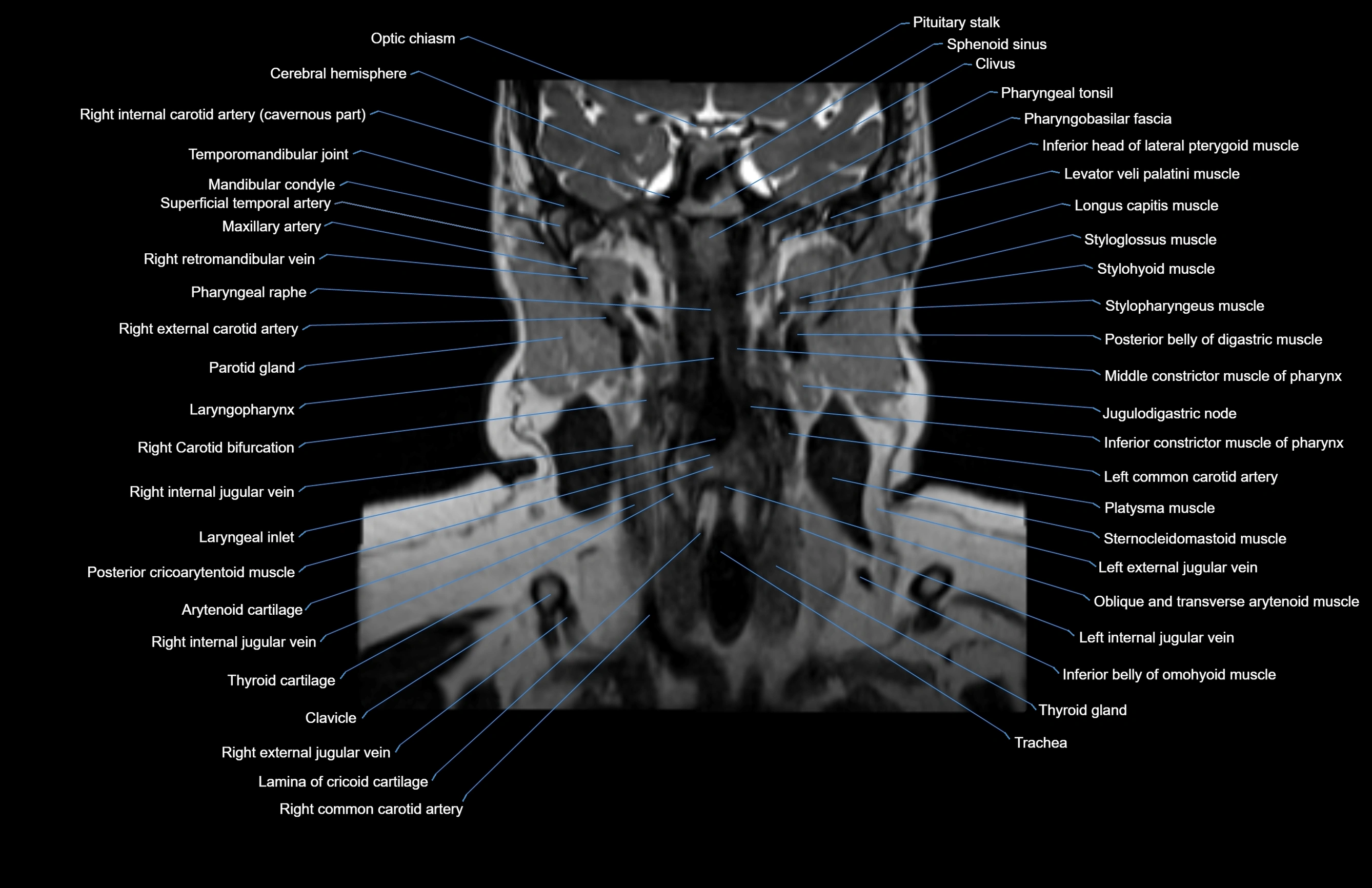 Neck coronal cross sectional MRI anatomy 3T MRI  image-img-00001-00039.webp